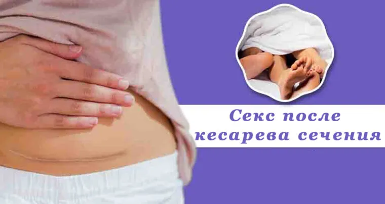 Секс после кесарева сечения