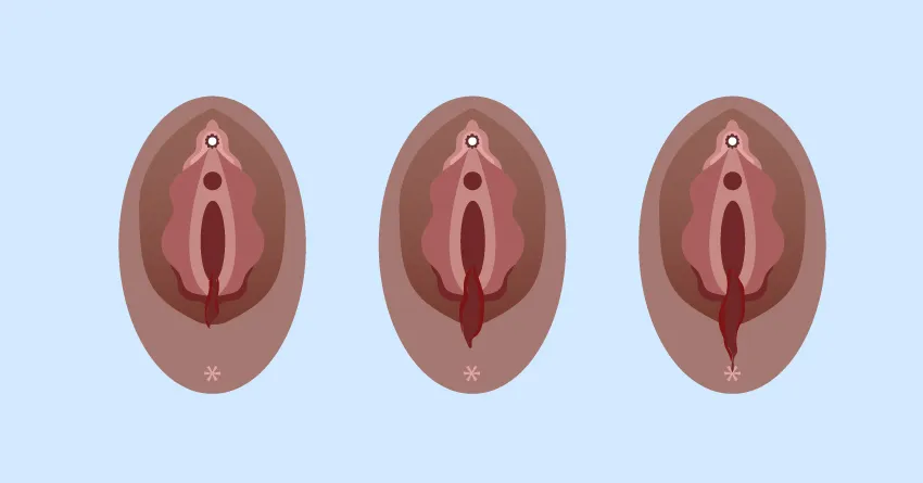 предотвращает эпизиотомию и уменьшает разрывы промежности