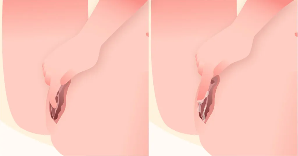 Вагинальное погружение